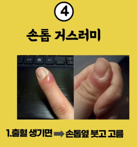 4손톱 거스러미.png