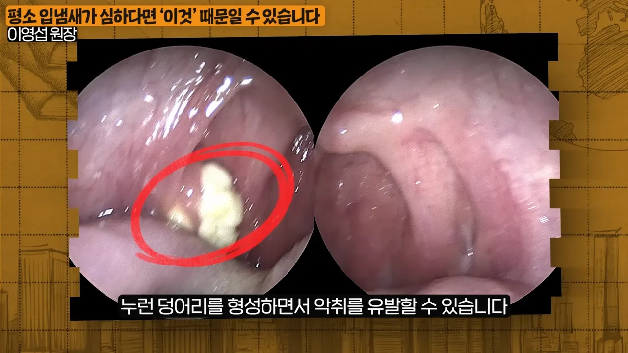 입냄새의 진짜 원인, 목에 낀 똥을 싹 없애는 간단한 방법 (이영섭 원장 2부) 1-10 screenshot.webp